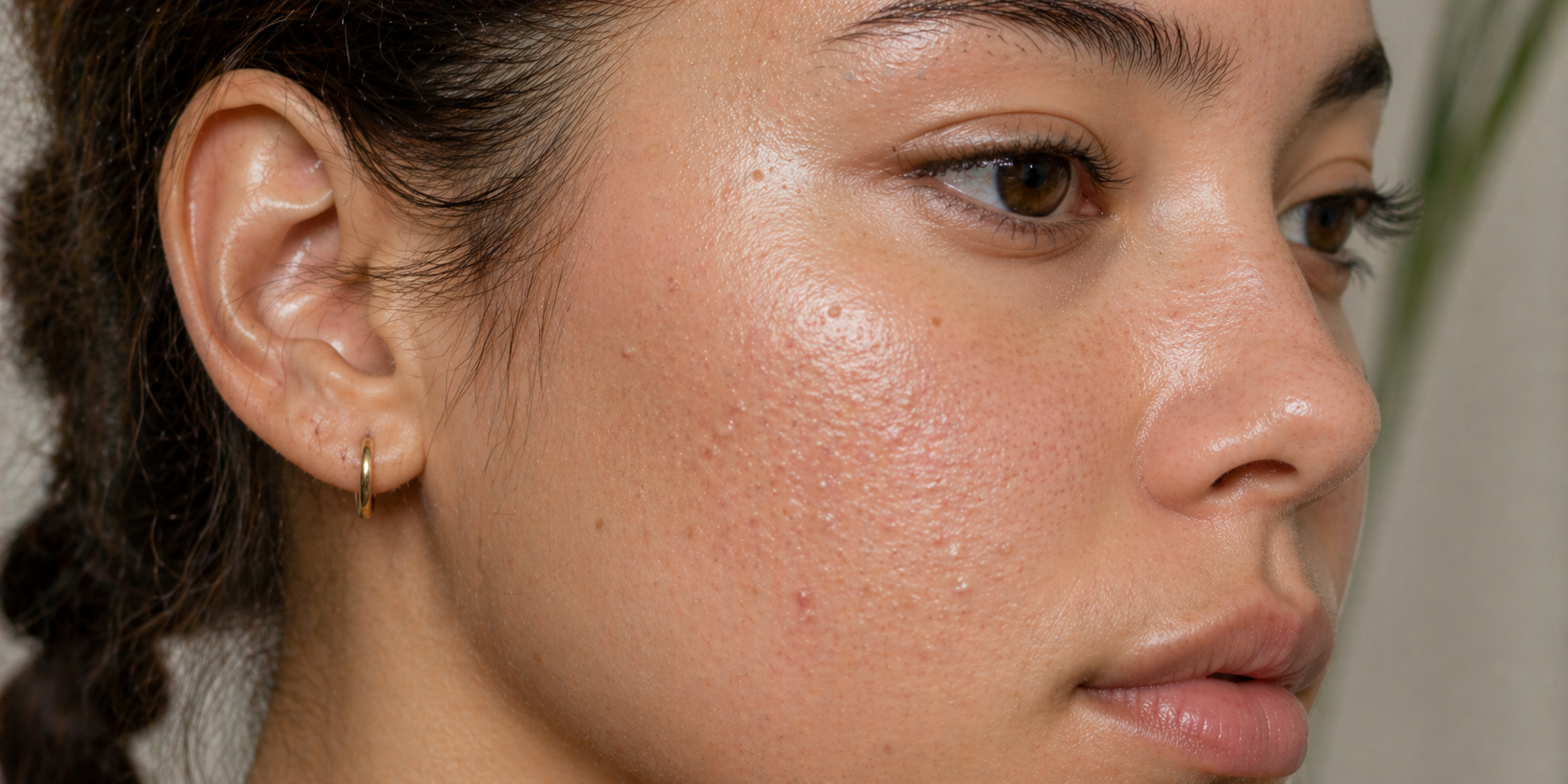 Peau Granuleuse